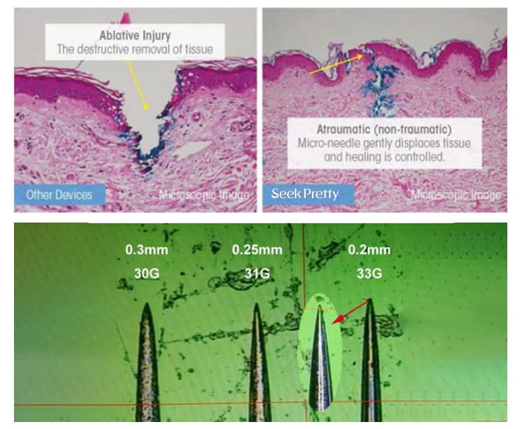 33G Ultra-fine needle comparison showing different gauge sizes