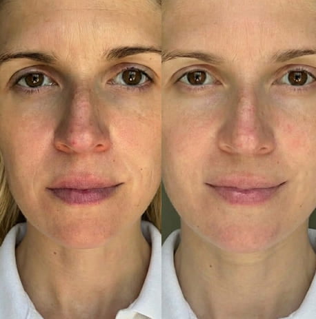 Before and after microneeding hydration