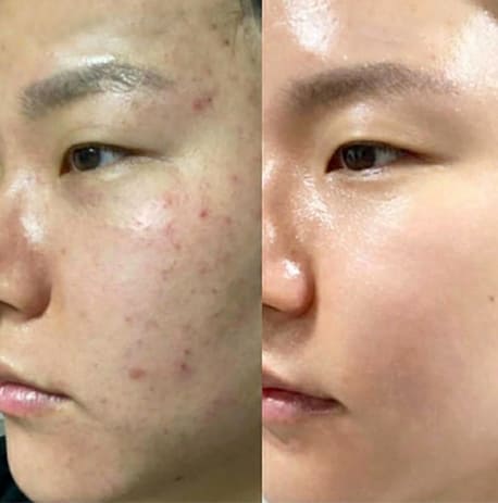 Microneedling anti-acne before and after
