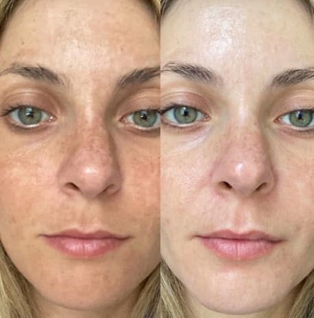 Microneedling dark spots before and after
