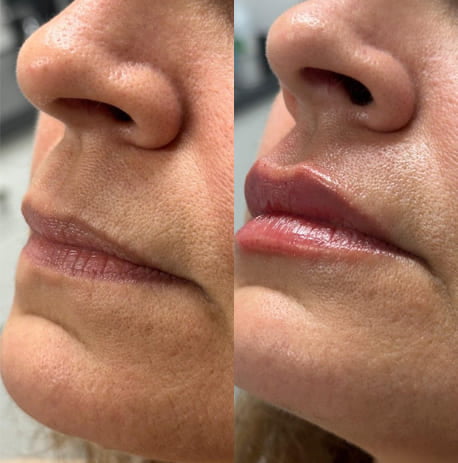 Microneedling lip area moisturizing