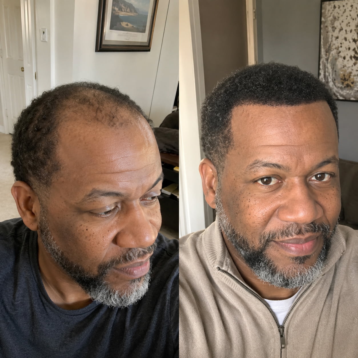 Customer microneedle hair result