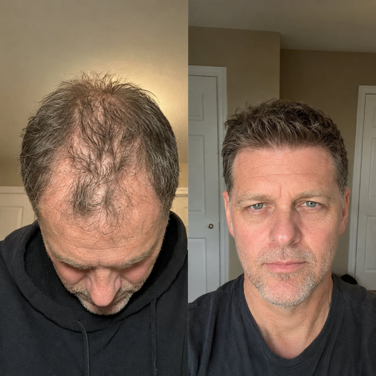 Customer hair restoration before and after result